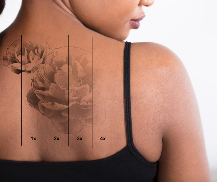 Msp Beauty Tatoo removal