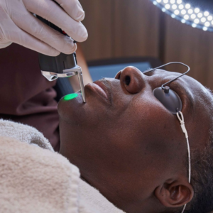 Laser Hair Removal (Face)