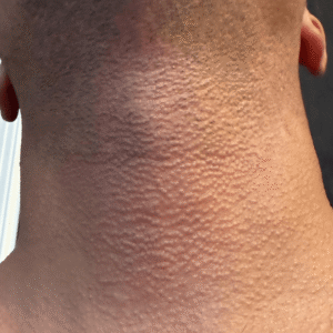 Laser Hair Removal (Front & Back Neck)
